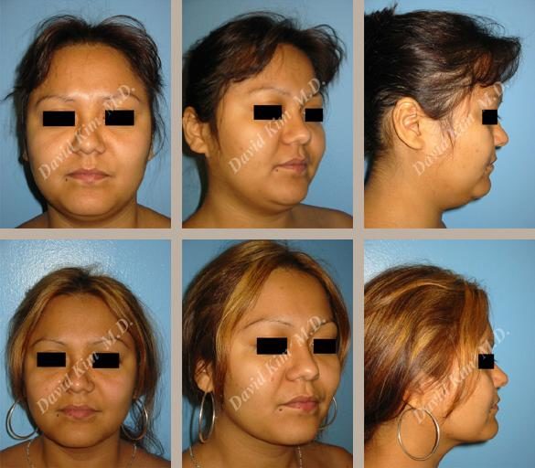 Image of patient post surgery