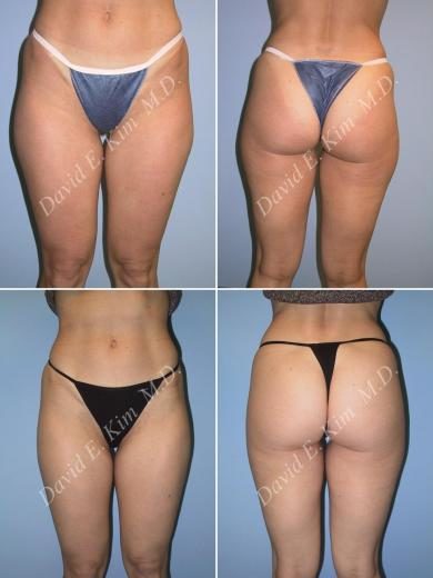 Image of patient post surgery
