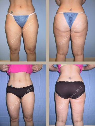 Image of patient post surgery