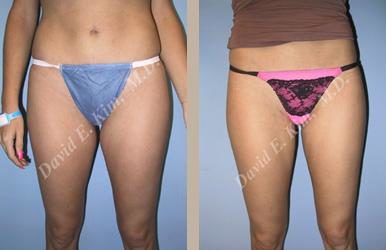 Image of patient post surgery