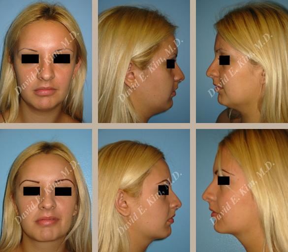 Image of patient post surgery