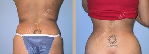 Image of patient post surgery