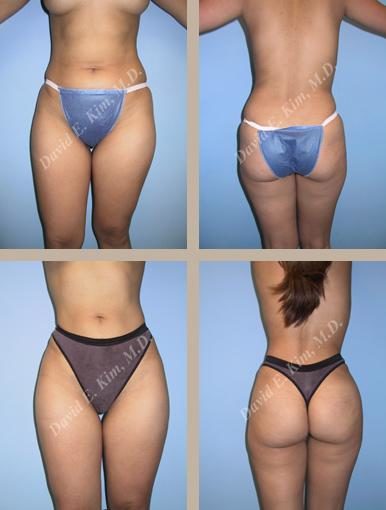 Image of patient post surgery
