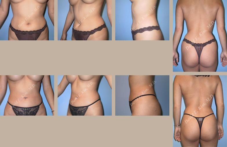Image of patient post surgery