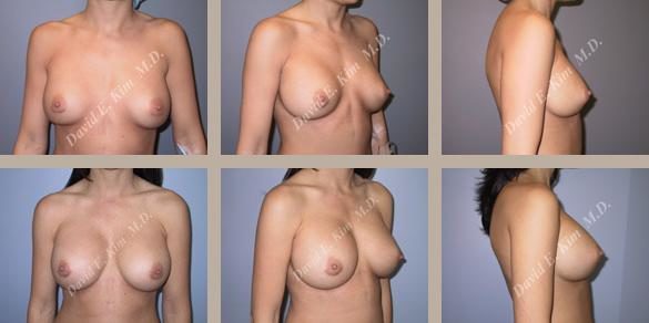 Breast Implant Revision Plastic Surgery Before And After Photos