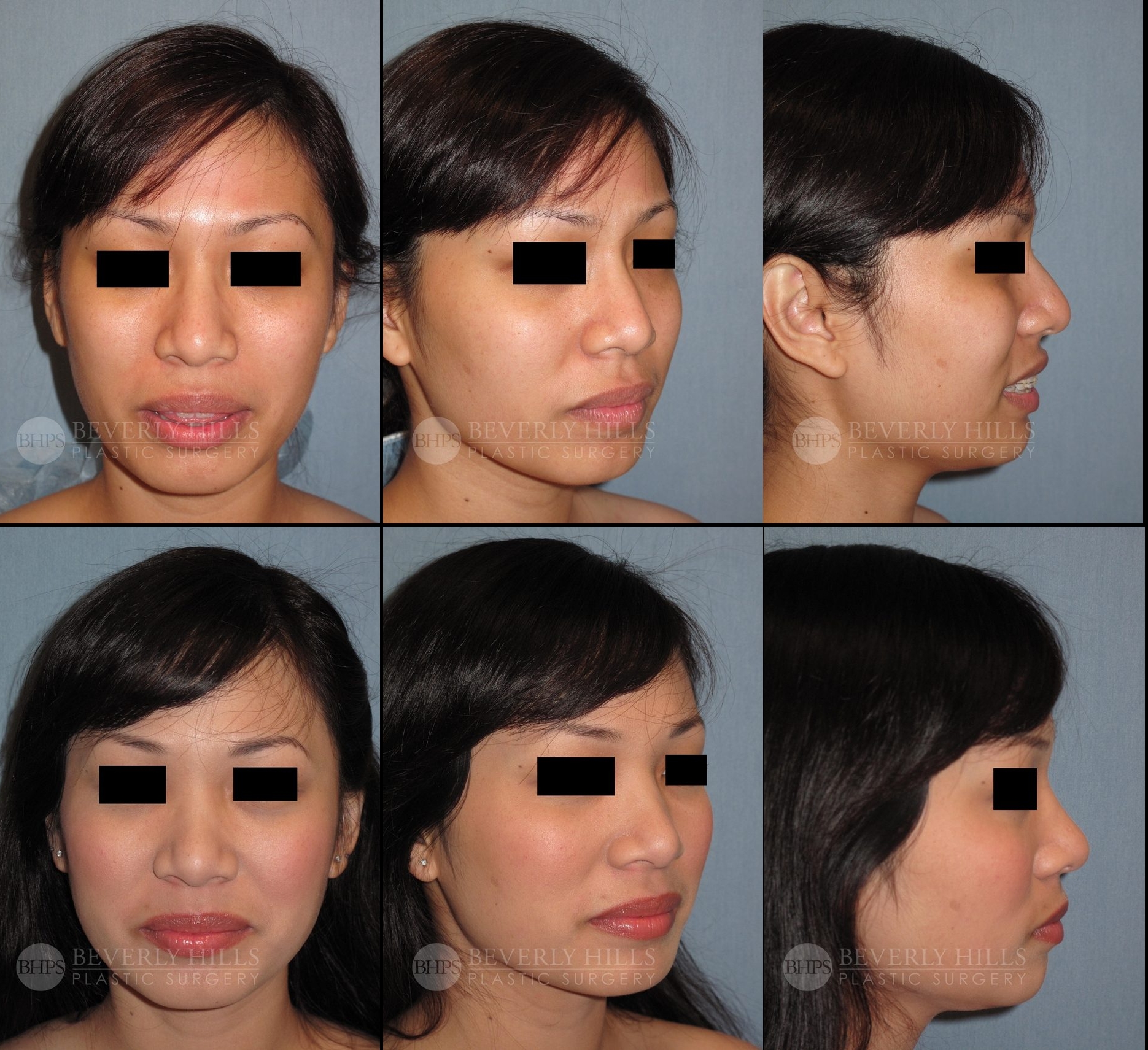 Image of patient post surgery