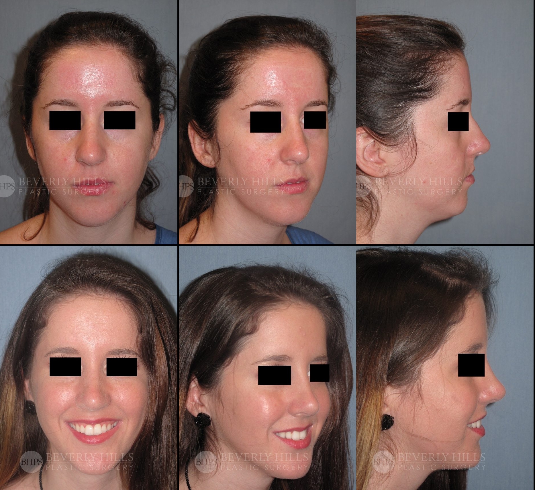 Image of patient post surgery